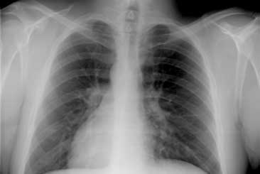 Chest xray