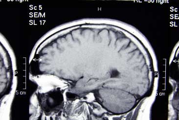 Brain mri