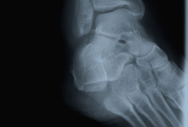 Xray foot