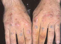 Hypersensitivity vasculitis: MedlinePlus Medical Encyclopedia